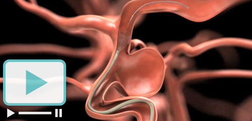 Akım yönlendirici stent ile anevrizma tedavisi